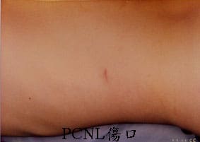 pcnl3.jpg