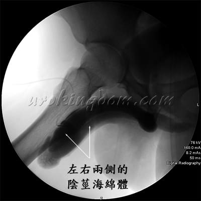 陰莖海綿體攝影檢查，白膜兩邊發育不對稱導致陰莖彎曲